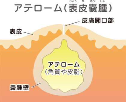 粉瘤（ふんりゅう/アテローム）とは