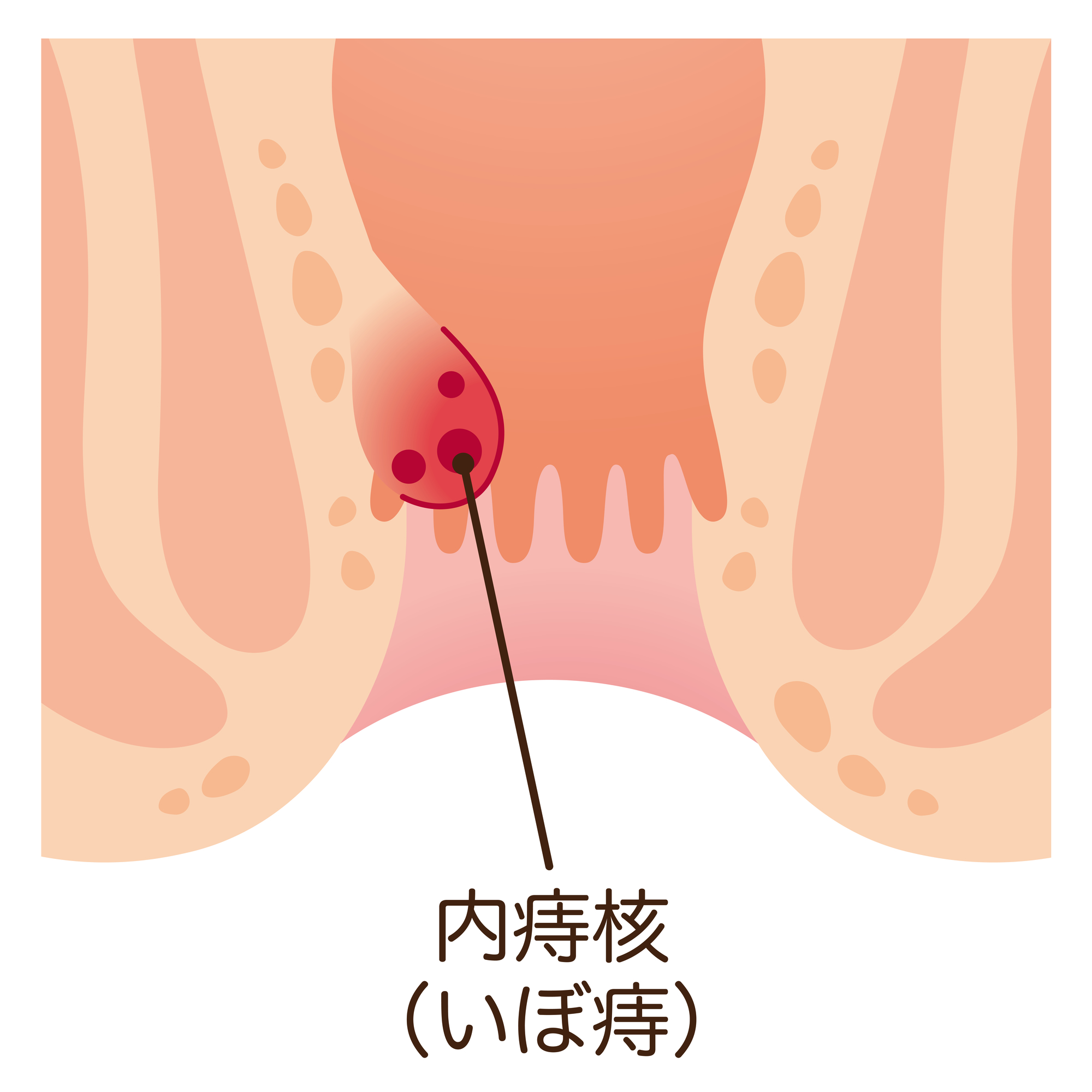 内痔核について