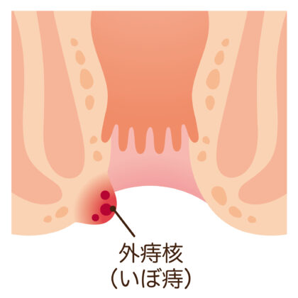 外痔核・血栓性外痔核について