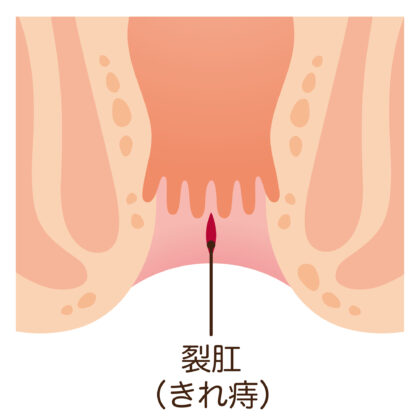 切れ痔（裂肛）とは