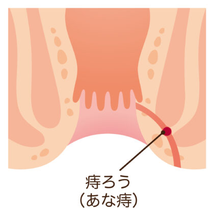 肛門周囲膿瘍が進行すると痔ろうに至ります