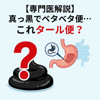 【専門医解説】真っ黒でベタベタ…これタール便？緊急度の目安と胃潰瘍・胃がんの可能性